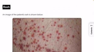 КЛИНИЧЕСКИЙ СЛУЧАЙ №1 / петехиальная сыпь / иммунная тромбоцитопеническая пурпура