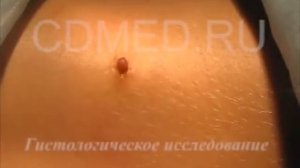 Удаление образований кожи (Сургитрон)