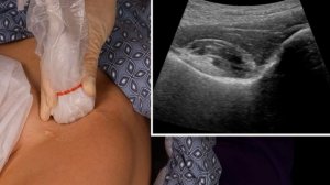 PENG Block (Pericapsular Nerve Group Block)