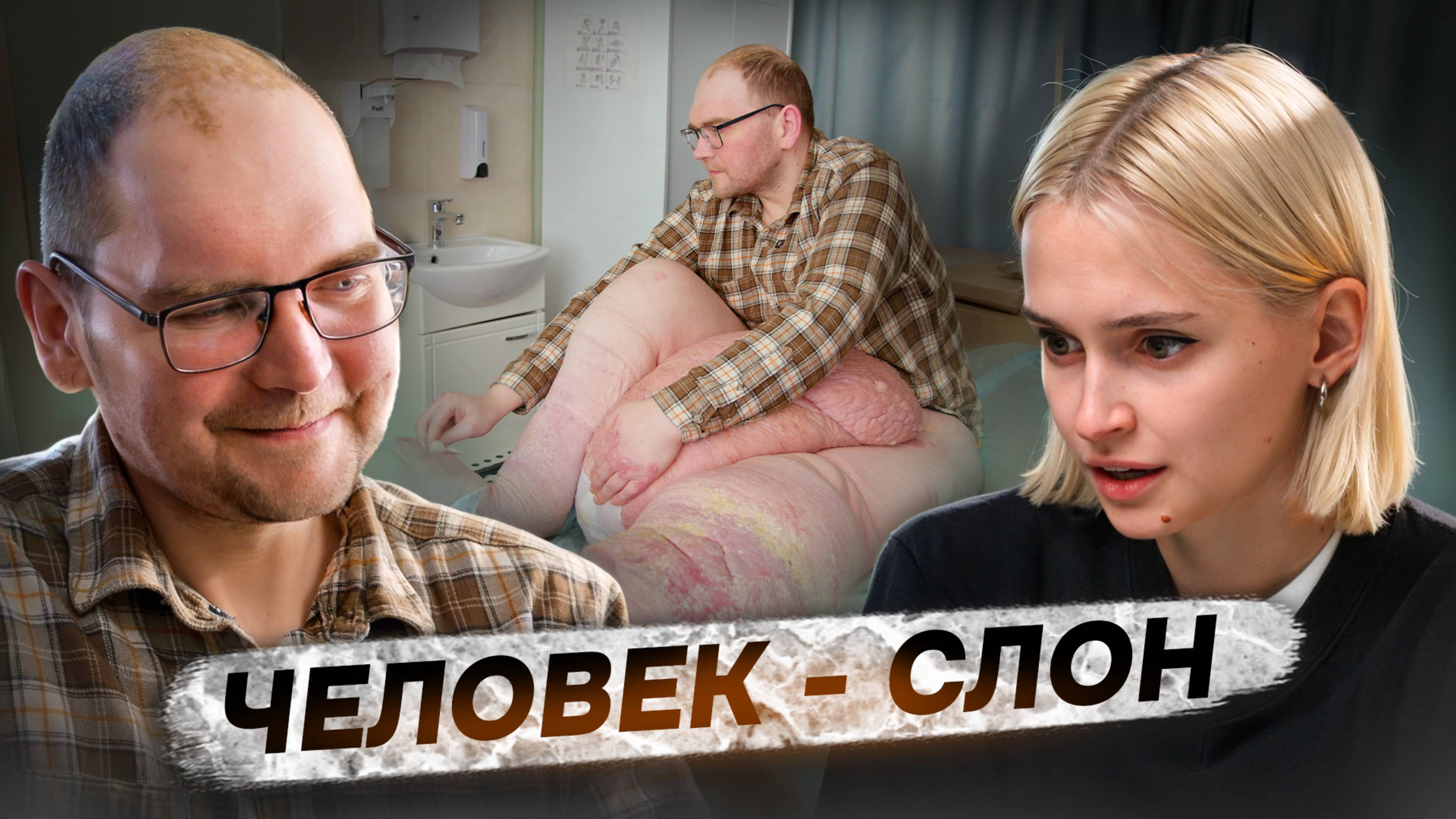 «Ношу на себе 80 кг» | Слоновья болезнь