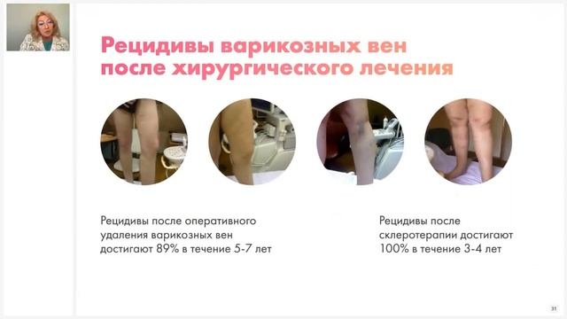 Можно ли избежать варикозного расширения вен?