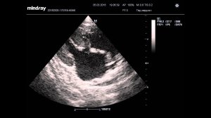 Расширение левого предсердия