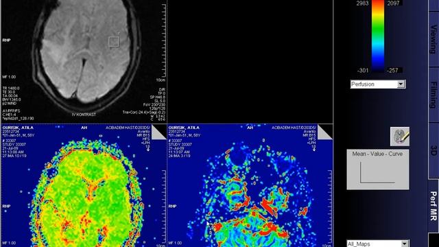 MRI Perfusion