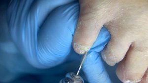 ФИБРОКЕРАТОМУ обнаружили под онихомикозом. Что делать? \\ педикюр с ROSILAK