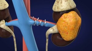 Robotic DaVinci radical nephrectomy