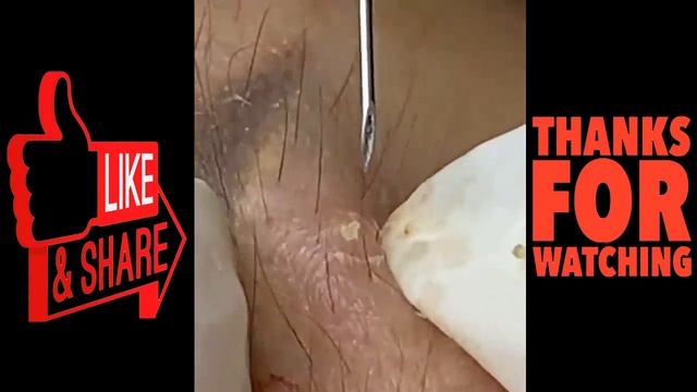 blackheads removepimples removalacne removal treatmentdr pimple popper nose 2021 11