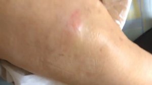 ДЕМЕНЦИЯ Альцгеймер Пролежни Dementia Alzheimer Bedsores