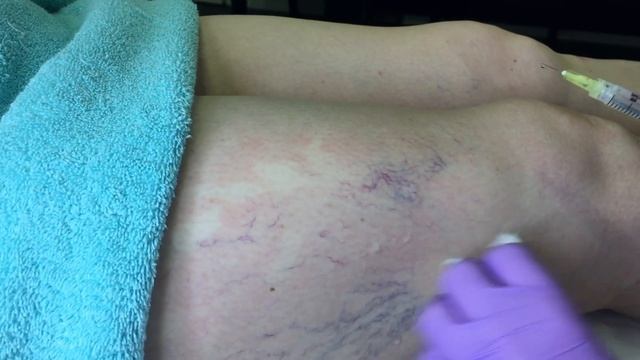 Sclerotherapy Leg Vein Treatment | The Laser and Skin Clinic
