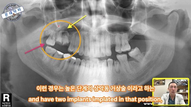 임플란트 대신 자가치아이식 된 사랑니가 브릿지 지대치로 사용될 수도