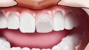 ASMR Remove Worm Infected & Heavy Tartar |  Deep Cleaning Animation