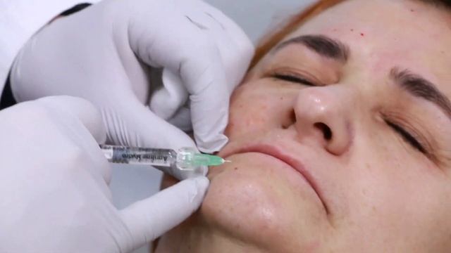 Mesotherapy injections with hyaluronic acid from Apriline Swiss