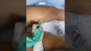 ЧЕМ ОПАСЕН ВАРИКОЗ? | ОПЕРАЦИЯ: ЛАЗЕРНОЕ УДАЛЕНИЕ ВЕНОЗНЫХ РАСШИРЕНИЙ