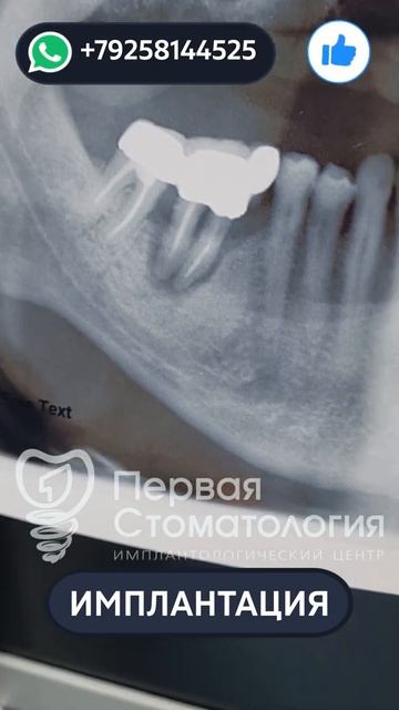 Имплантация зубов пациенту. Подвижный мост №1
