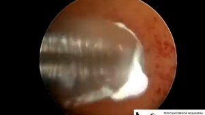 Гистероскопия (удаление полипа + рассечение внутриматочных синехий)