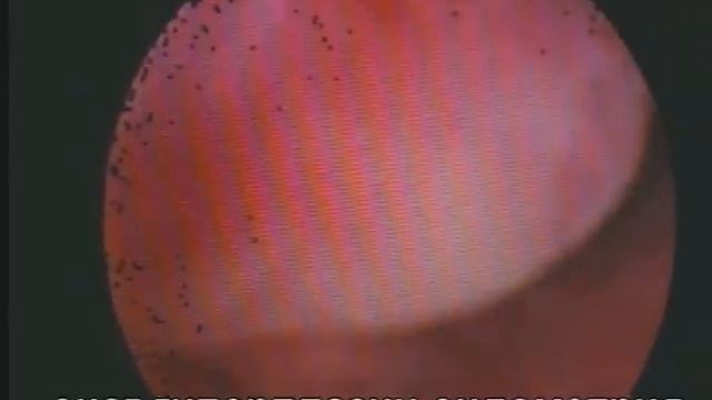Гиперплазия эндометрия и полип.