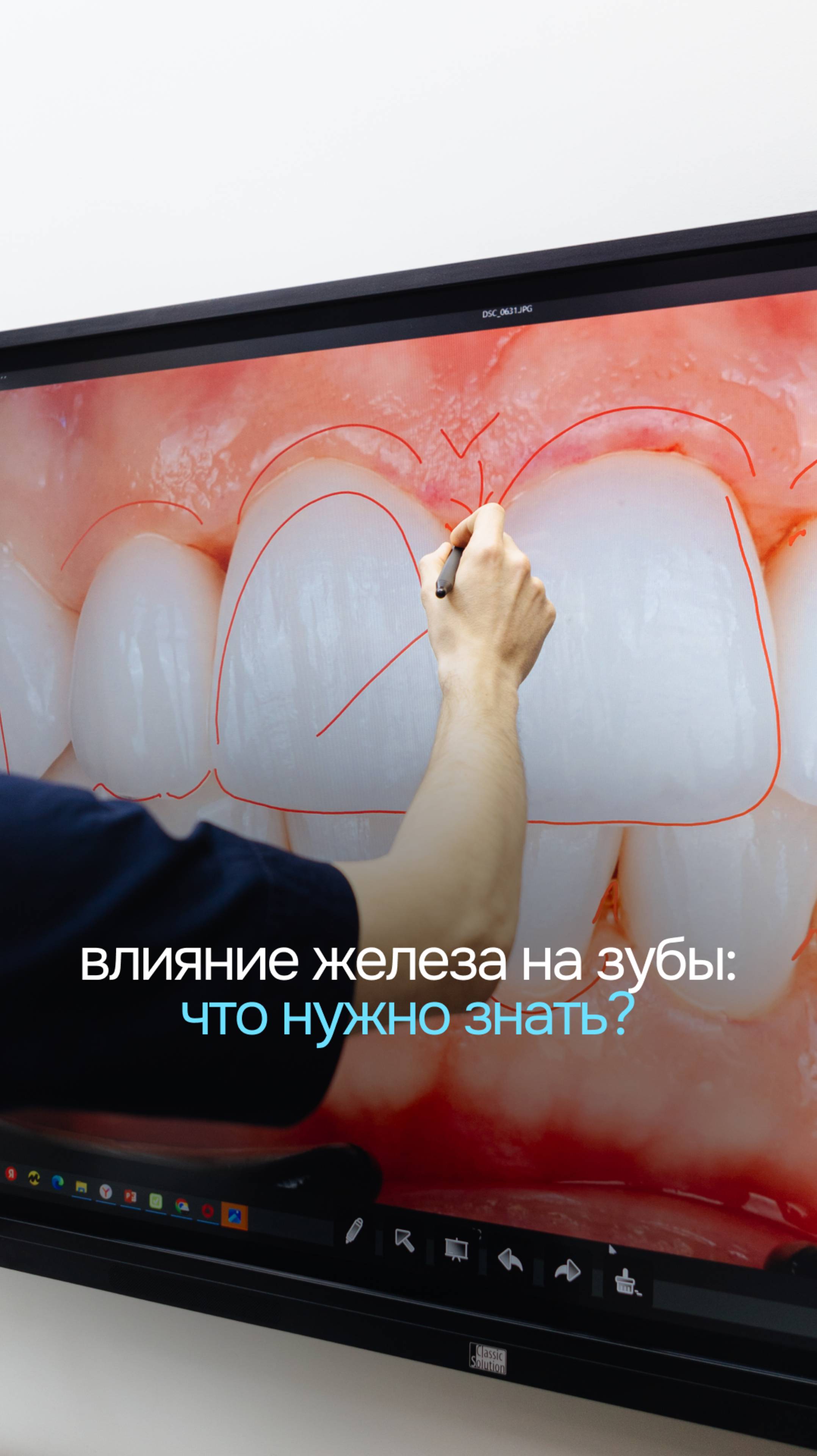 Почему излишки этого витамина могут приводить к ухудшению состояния эмали? Смотрите до конца⬆️