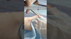Вросший ноготь. Краевая резекция ногтевой пластины.