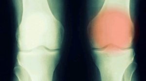 Это рак костей-успевайте во время