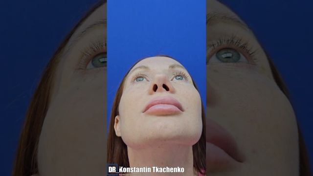 ПОВТОРНАЯ РИНОСЕПТОПЛАСТИКА.
В конце смотрите результат.