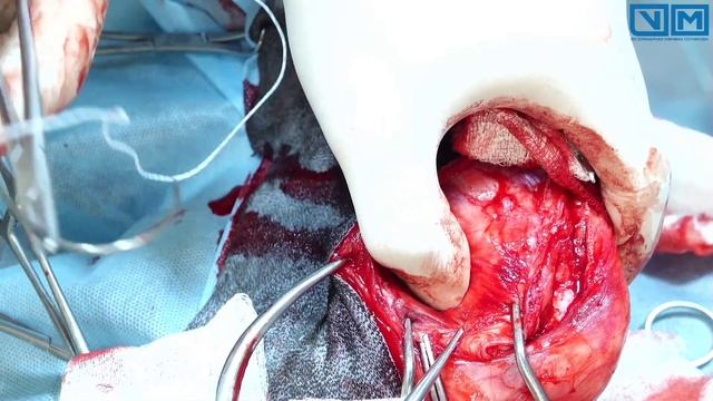 Фабелотибиальный шов смотреть онлайн