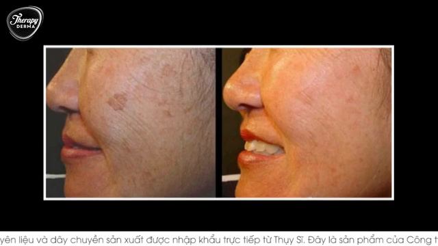 truoc sau su dung kem tri nam therapy derma