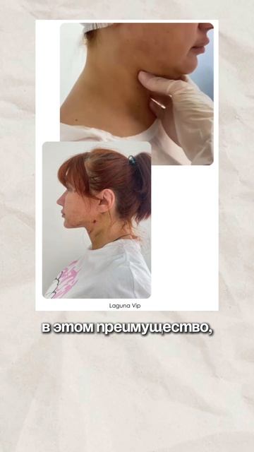 Лазерный липолиз
