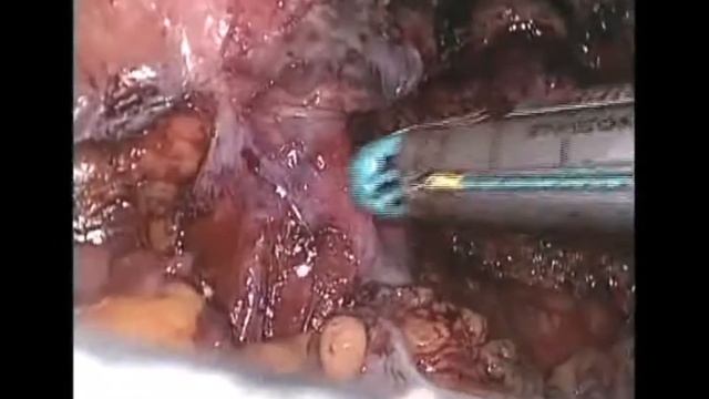 Rectal endometriosis - TLH with Rectal resection and anastomosis смотреть онлайн