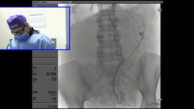 Transradial Uterine Artery Embolization (TRUFE) of Symptomatic Uterine Fibroids