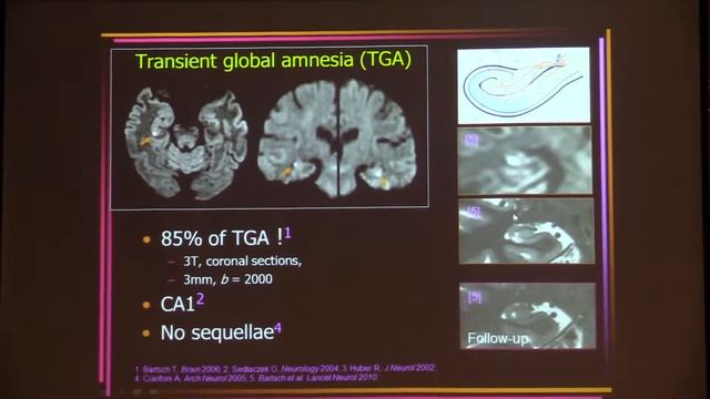 MRI in Transient Ischemic Attack: a Waste of Imaging Resources ? - Catherine Oppenheim