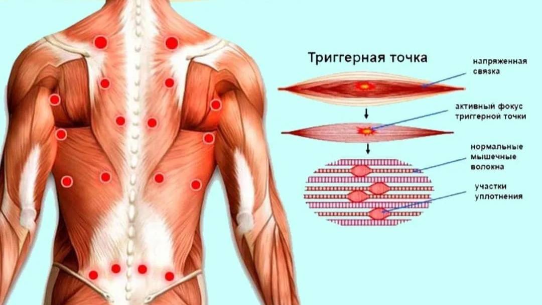 Триггерные точки