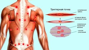 Триггерные точки