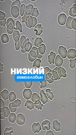 Если гемоглобин низкий, ваша кровь выглядит так. Алена Братишко