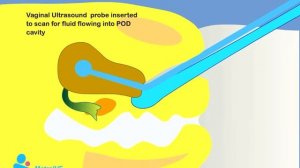 Эхогистеросальпингоскопия схема