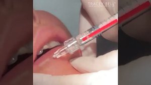 Belotero Lips - Treating lines around the mouth - Timelapse Video