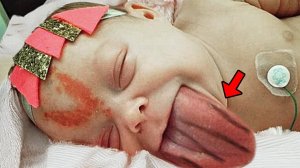 Помните девочку, родившуюся с большим языком? Вы не поверите, как она выглядит сейчас!