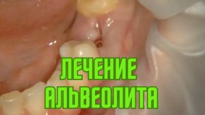 💥 Лечение альвеолита с помощью Clot PRF