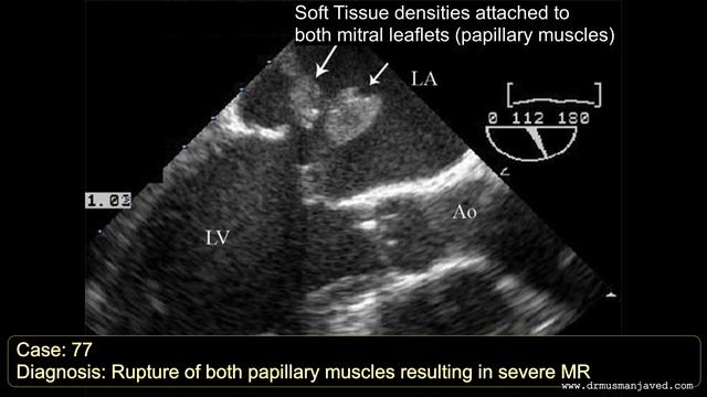 ECHO CASE 77 | Echocardiography Spot Diagnosis Series | Echocardiogram Interpretation