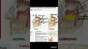 ПроЗдоровье.Операция на верхнечелюстной пазухе.Фильм1.Серия2.mp4