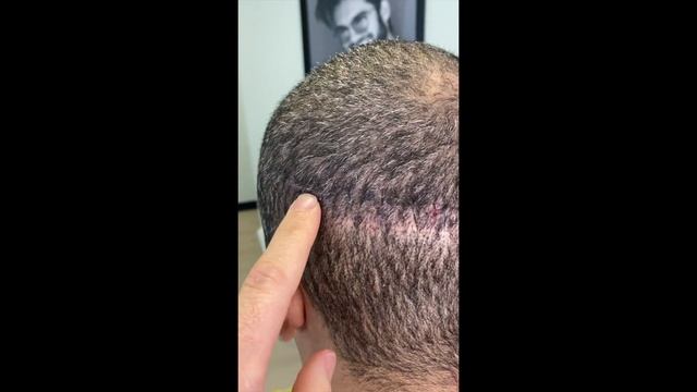 How Big is a FUT Hair Transplant Scar? Natural Transplants vs Others | Dr. Blumenthal смотреть онлайн