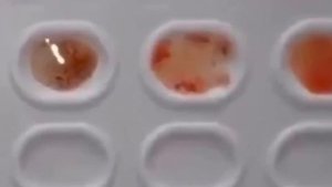 TSOLIKLONLAR YORDAMIDA QON GURUXI VA REZUS OMILINI ANIQLASH