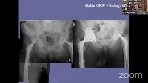 Surgical tips and tricks in revision hip arthroplasty ( Prof. Douglas Dunlop )