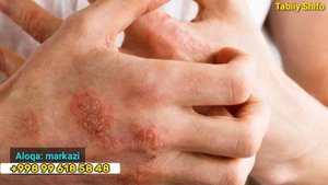 эшак еми касаллигини давоси тарвок касаллиг сабаблари ва Уни даволаш Tarmoqni uyda tabiiy davolash