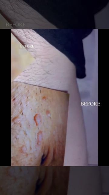 HPV Genital warts treatment by HPV BCR ™️ testimonial before and after photo and video смотреть онлайн