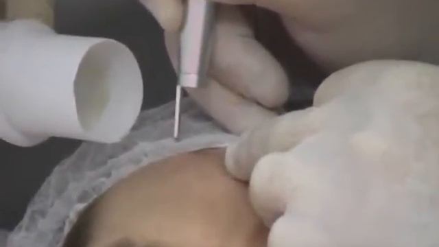 Лазерное удаление атеромы