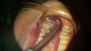 Интрасептальная анестезия.