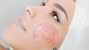 Сосудистые звездочки на теле