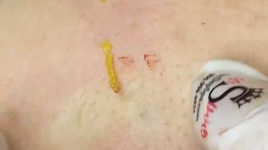 Satisfying Relaxing Maryim Prise. #acne #blackheads #whiteheads #treatments #pimple #акне #прыщи