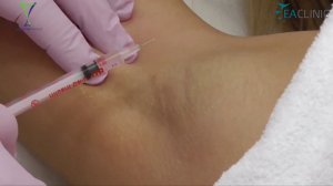 Удаление папиллом на радиоволновом аппарате Greenland Medical RFS 3800K