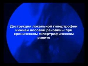 Деструкция локальной гипертрофии нижней носовой раковины при хроническом гипертрофическом рините