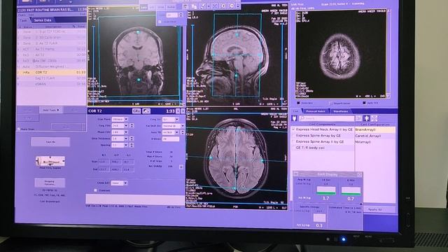 Mri routine brain & تقنيات تصوير الدماغ باستخدام الرنين المغناطيسي (MRI) -  T1 و T2 و FLAIR :